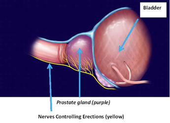 Robotic Radical Prostatectomy